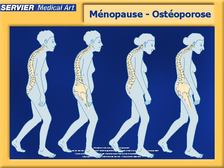 Ménopause - Ostéoporose Utilisation non commerciale uniquement. Les images de Servier Medical Art sont