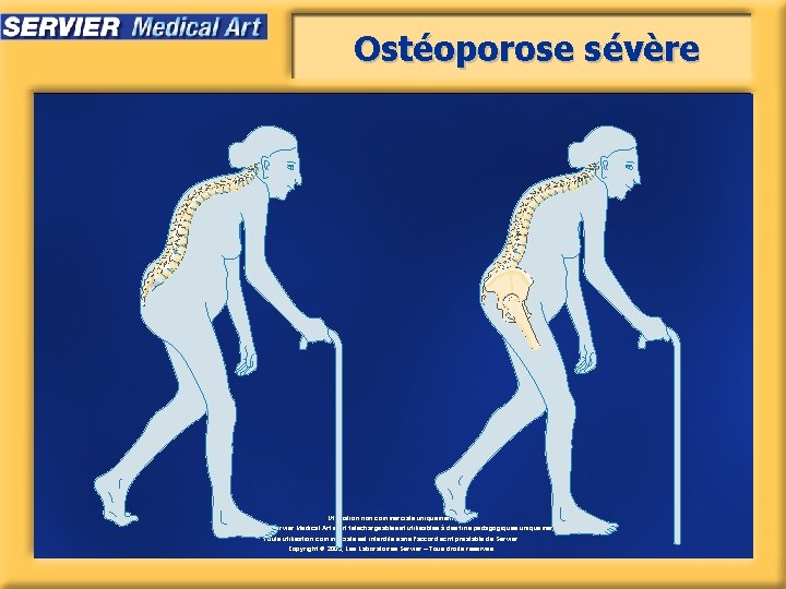 Ostéoporose sévère Utilisation non commerciale uniquement. Les images de Servier Medical Art sont téléchargeables