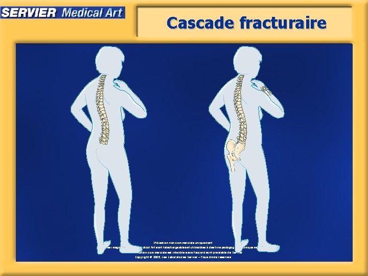 Cascade fracturaire Utilisation non commerciale uniquement. Les images de Servier Medical Art sont téléchargeables