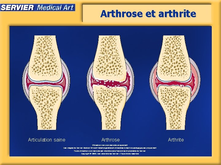 Arthrose et arthrite Articulation saine Arthrose Utilisation non commerciale uniquement. Les images de Servier