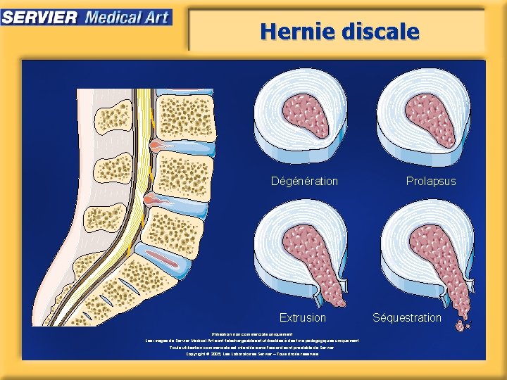 Hernie discale Dégénération Extrusion Utilisation non commerciale uniquement. Les images de Servier Medical Art