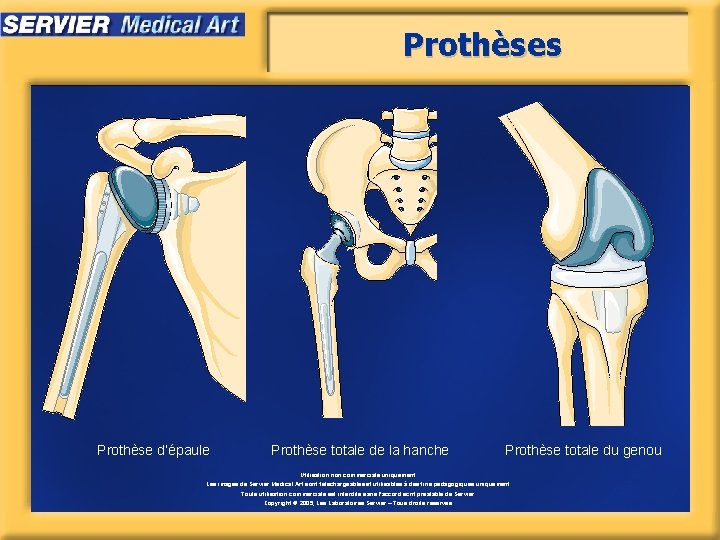 Prothèses Prothèse d’épaule Prothèse totale de la hanche Prothèse totale du genou Utilisation non