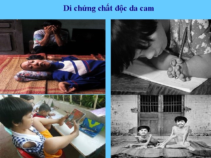 Di chứng chất độc da cam 