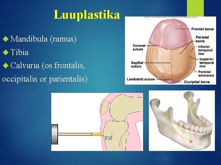 Luuplastika Mandibula (ramus) Tibia Calvaria (os frontalis, occipitalis or parientalis) 