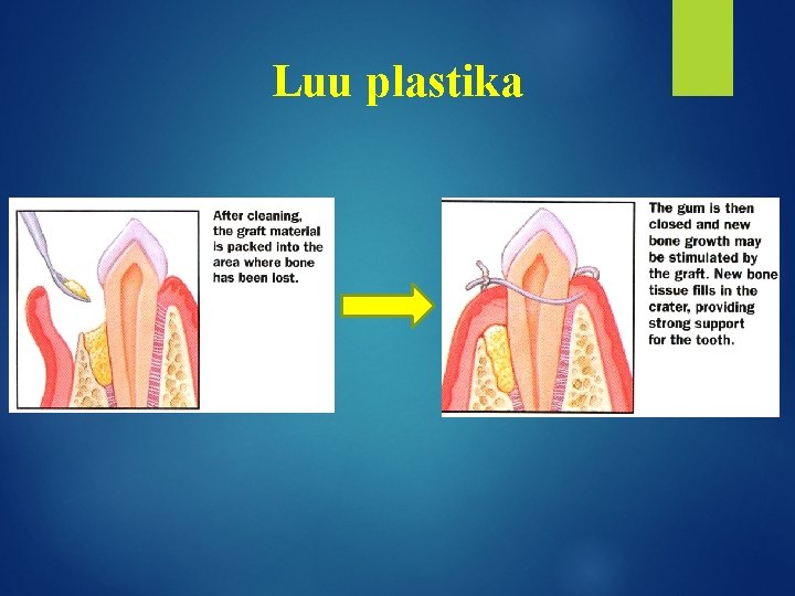 Luu plastika 