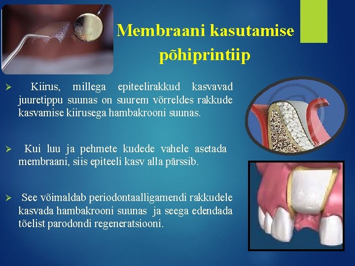 Membraani kasutamise põhiprintiip Ø Kiirus, millega epiteelirakkud kasvavad juuretippu suunas on suurem võrreldes rakkude