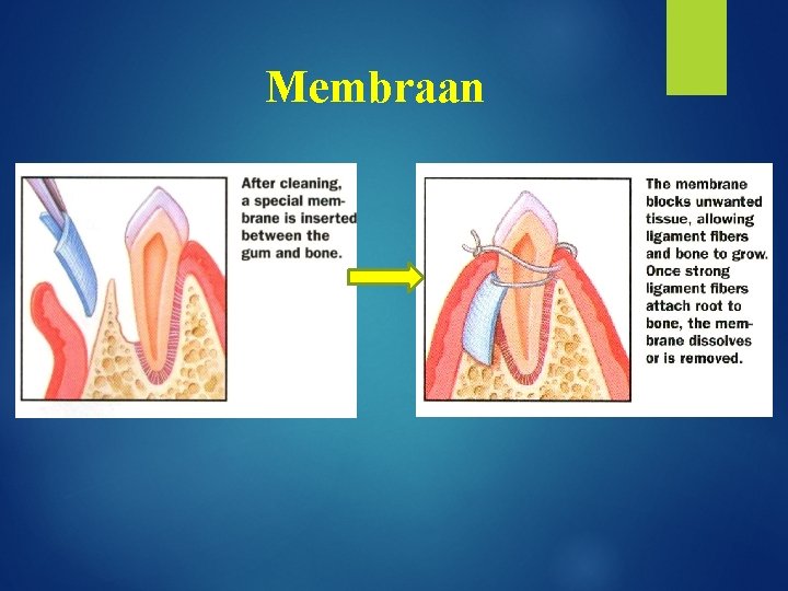 Membraan 