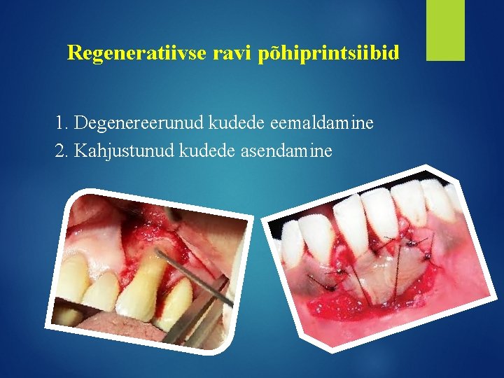 Regeneratiivse ravi põhiprintsiibid 1. Degenereerunud kudede eemaldamine 2. Kahjustunud kudede asendamine 