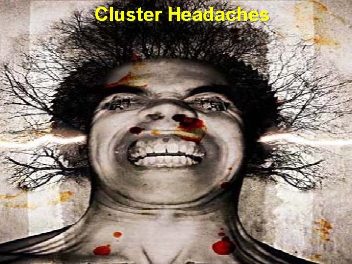 Cluster Headaches 1/3/2022 25 