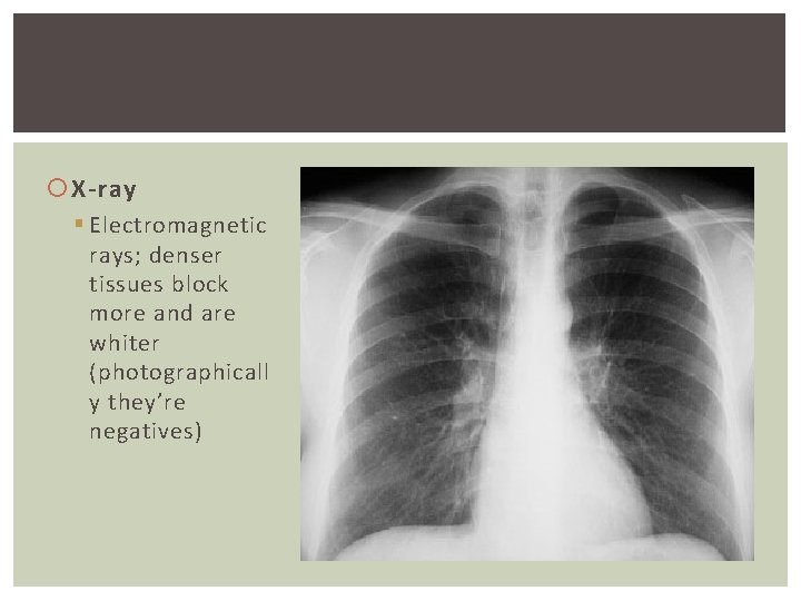  X-ray § Electromagnetic rays; denser tissues block more and are whiter (photographicall y