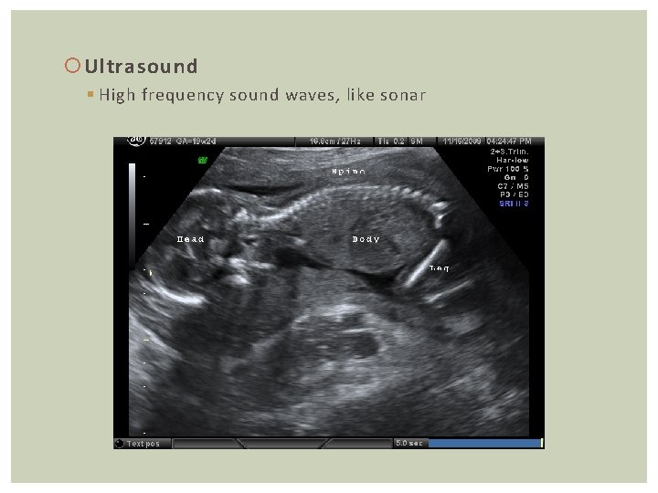  Ultrasound § High frequency sound waves, like sonar 