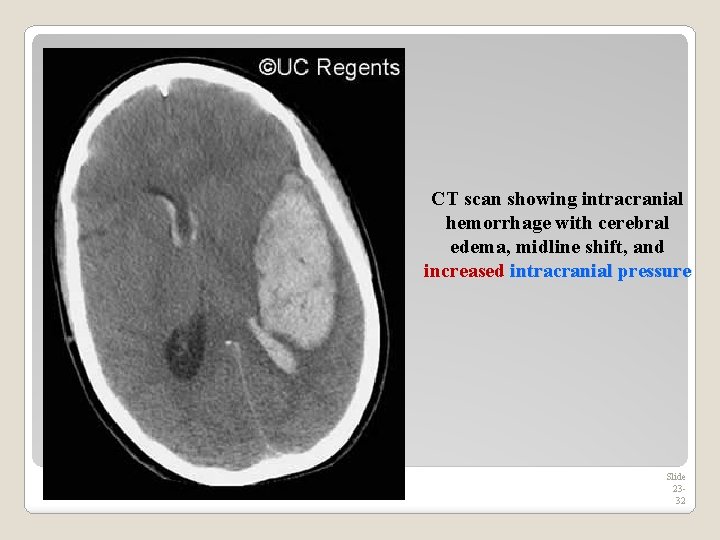 CT scan showing intracranial hemorrhage with cerebral edema, midline shift, and increased intracranial pressure