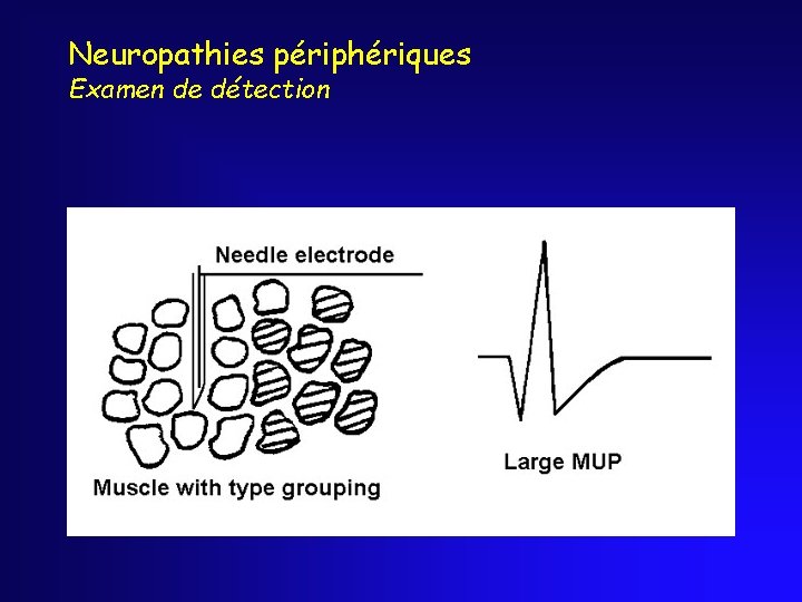 Neuropathies périphériques Examen de détection 