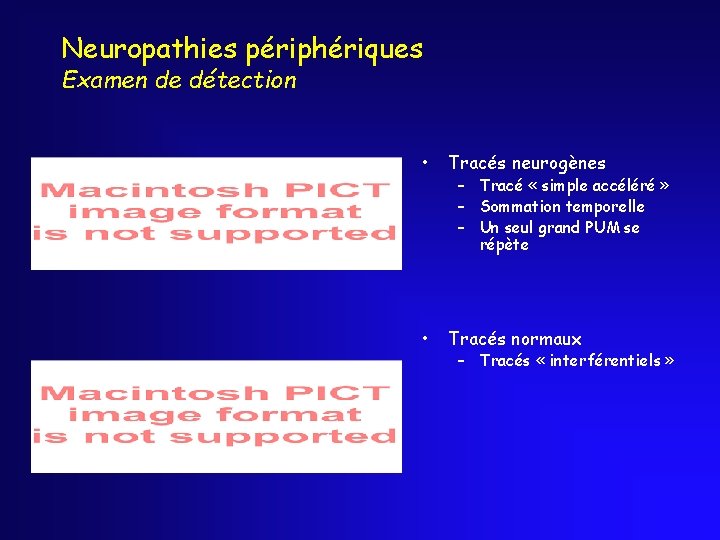 Neuropathies périphériques Examen de détection • Tracés neurogènes • Tracés normaux – Tracé «