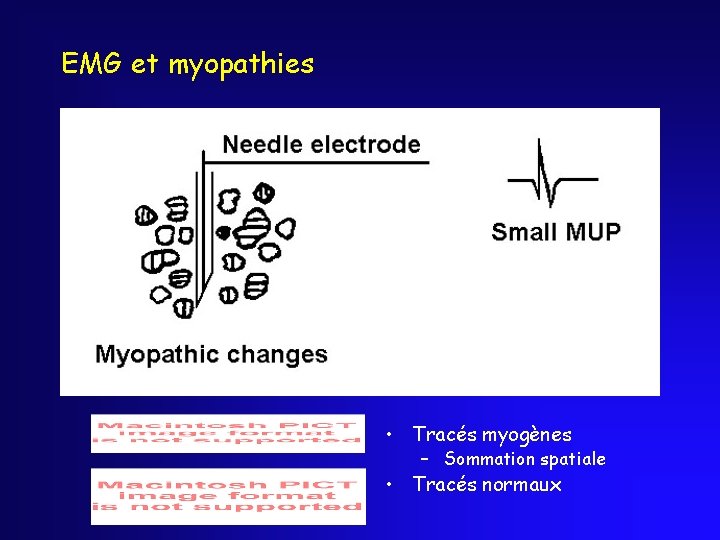 EMG et myopathies • Tracés myogènes – Sommation spatiale • Tracés normaux 