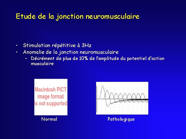 Etude de la jonction neuromusculaire • Stimulation répétitive à 3 Hz • Anomalie de