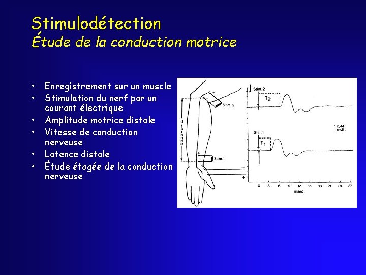 Stimulodétection Étude de la conduction motrice • • • Enregistrement sur un muscle Stimulation