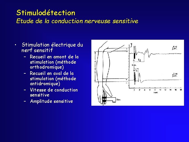 Stimulodétection Etude de la conduction nerveuse sensitive • Stimulation électrique du nerf sensitif –