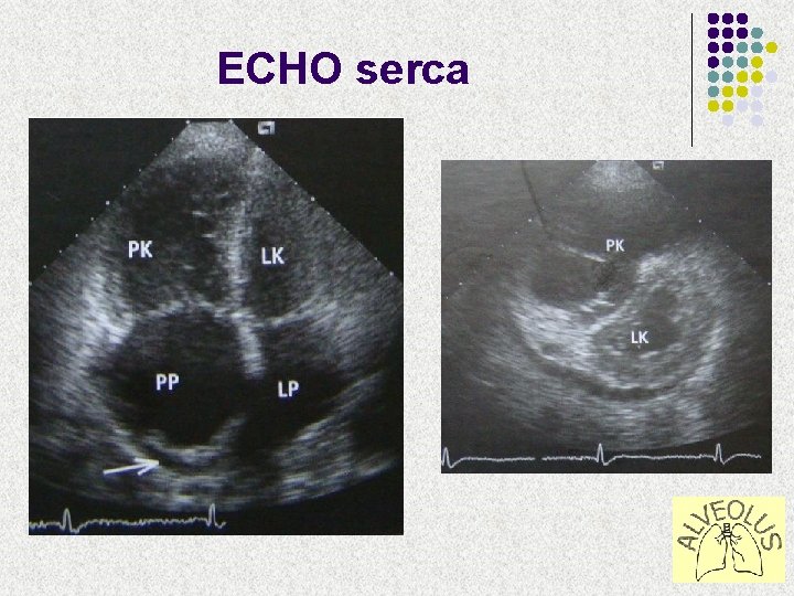 ECHO serca 