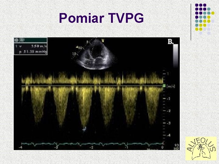 Pomiar TVPG 