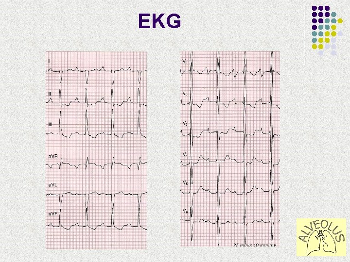 EKG 