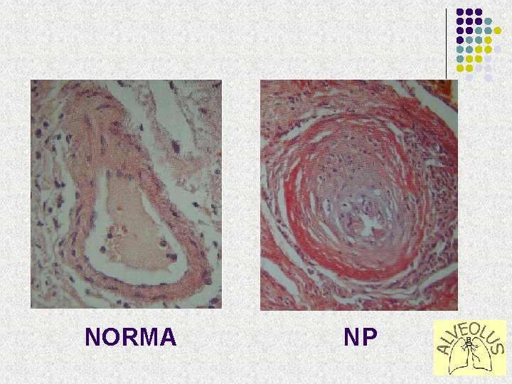 NORMA NP 