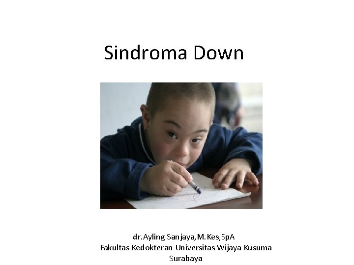 Sindroma Down dr. Ayling Sanjaya, M. Kes, Sp. A Fakultas Kedokteran Universitas Wijaya Kusuma