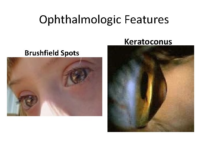 Ophthalmologic Features Keratoconus Brushfield Spots 