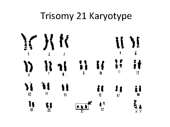 Trisomy 21 Karyotype 