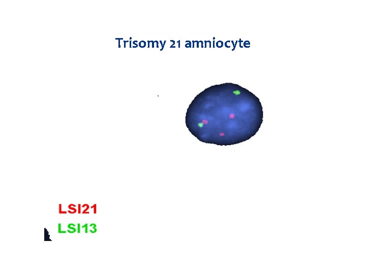 Trisomy 21 amniocyte 