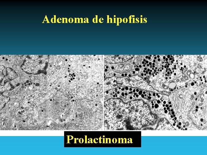 Adenoma de hipofisis Prolactinoma Antonio Ferrández Izquierdo 