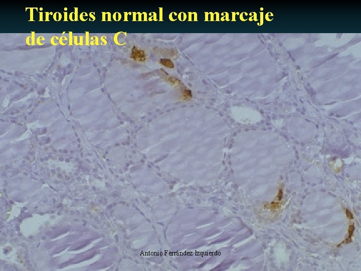 Tiroides normal con marcaje de células C Antonio Ferrández Izquierdo 