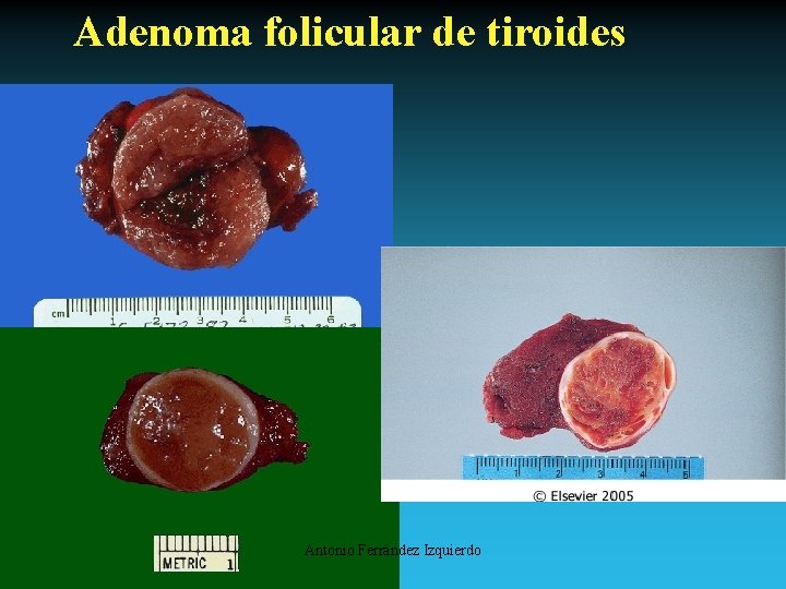 Adenoma folicular de tiroides Antonio Ferrández Izquierdo 