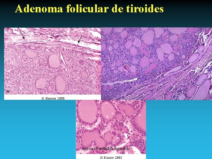 Adenoma folicular de tiroides Antonio Ferrández Izquierdo 