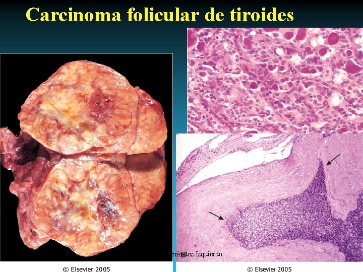 Carcinoma folicular de tiroides Antonio Ferrández Izquierdo 