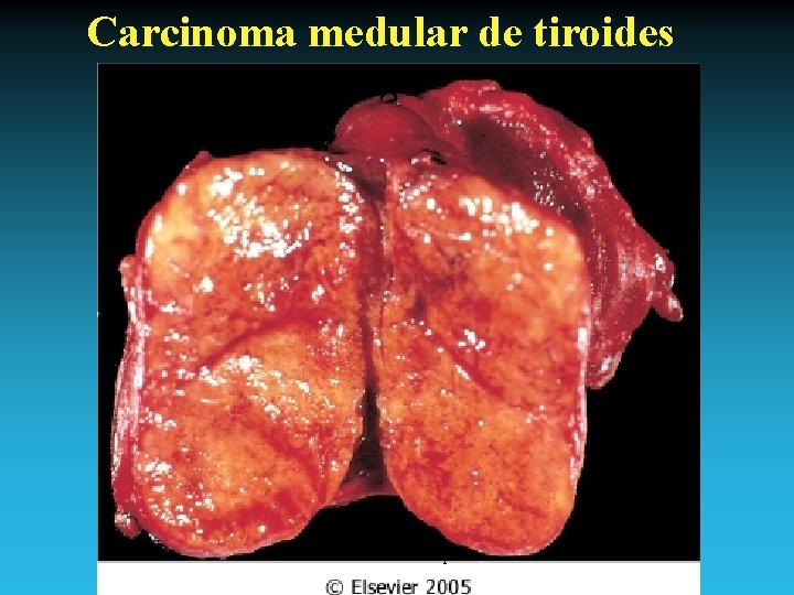 Carcinoma medular de tiroides Antonio Ferrández Izquierdo 