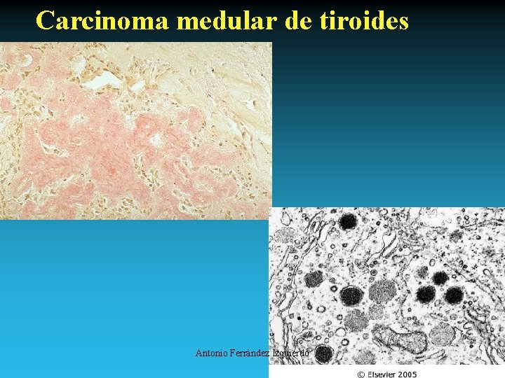 Carcinoma medular de tiroides Antonio Ferrández Izquierdo 