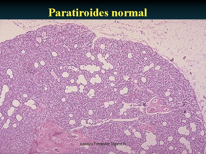 Paratiroides normal Antonio Ferrández Izquierdo 