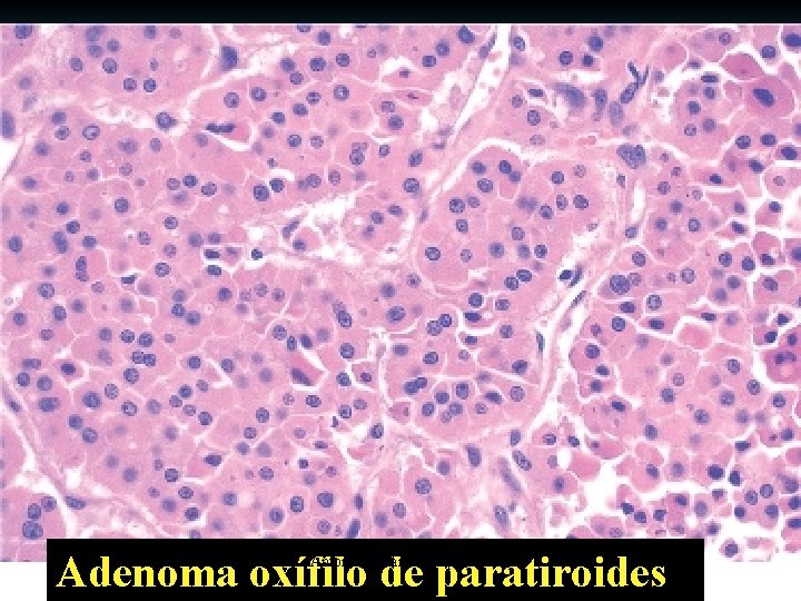 Adenoma oxífilo de paratiroides Antonio Ferrández Izquierdo 