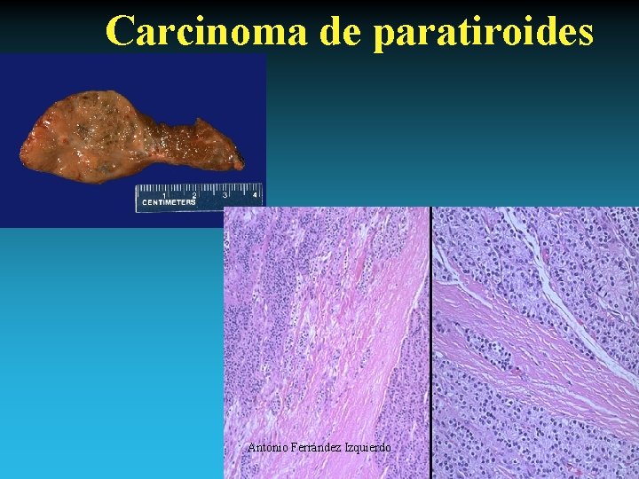 Carcinoma de paratiroides Antonio Ferrández Izquierdo 