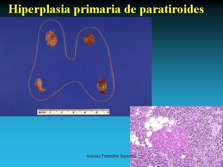 Hiperplasia primaria de paratiroides Antonio Ferrández Izquierdo 