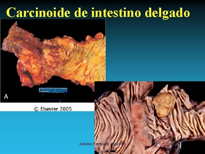 Carcinoide de intestino delgado Antonio Ferrández Izquierdo 