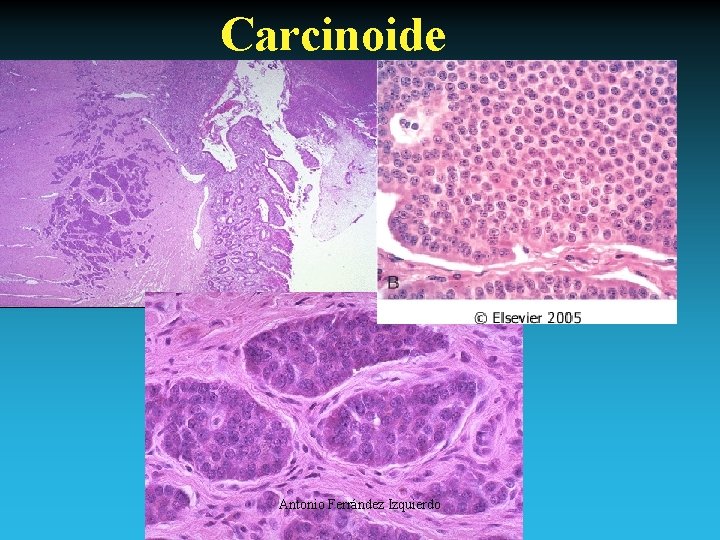 Carcinoide Antonio Ferrández Izquierdo 