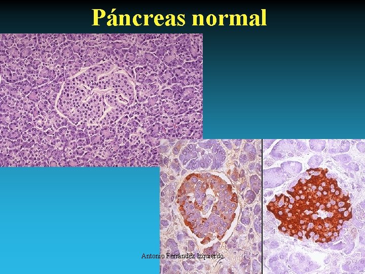 Páncreas normal Antonio Ferrández Izquierdo 