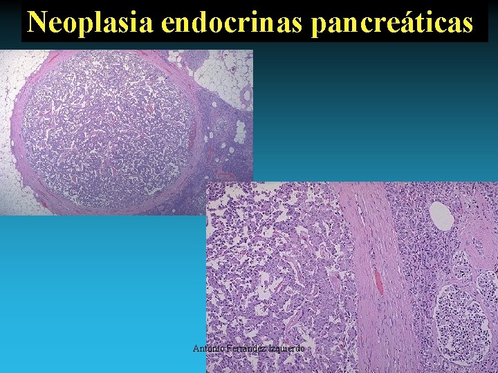 Neoplasia endocrinas pancreáticas Antonio Ferrández Izquierdo 