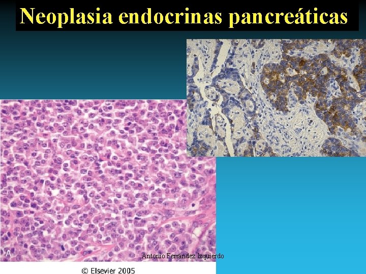 Neoplasia endocrinas pancreáticas Antonio Ferrández Izquierdo 