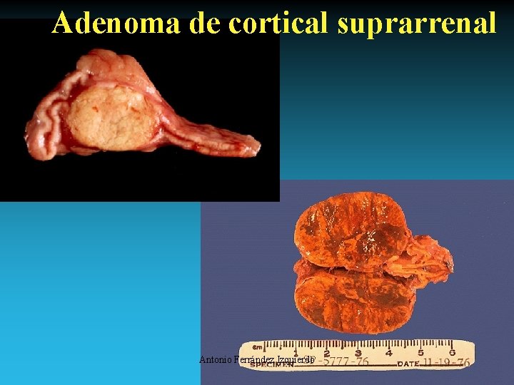 Adenoma de cortical suprarrenal Antonio Ferrández Izquierdo 