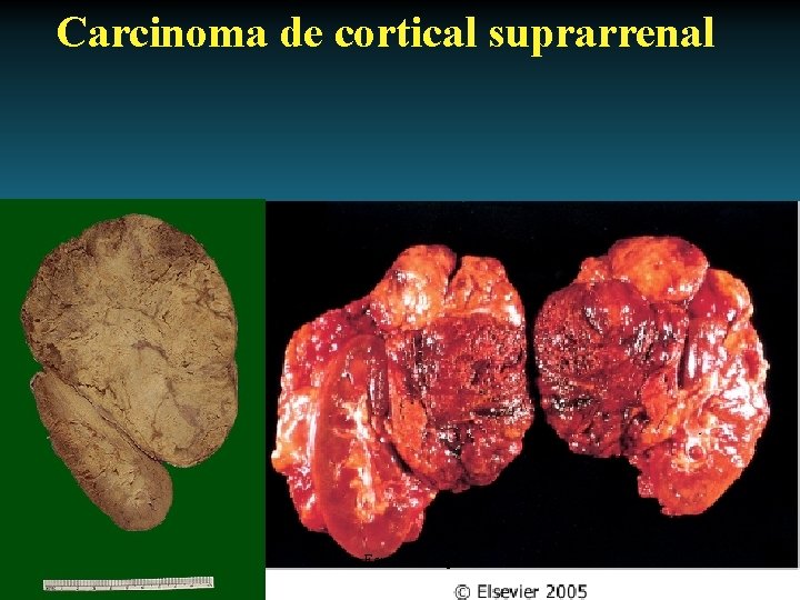 Carcinoma de cortical suprarrenal Antonio Ferrández Izquierdo 
