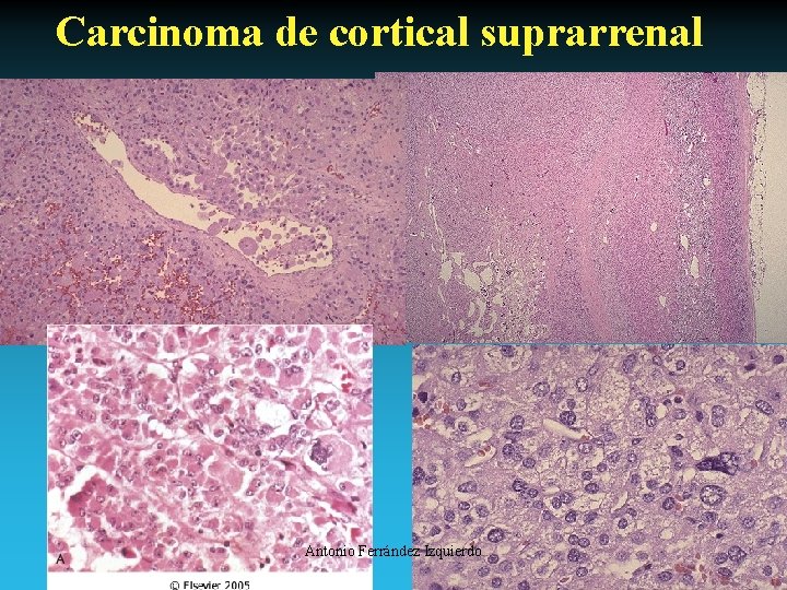 Carcinoma de cortical suprarrenal Antonio Ferrández Izquierdo 