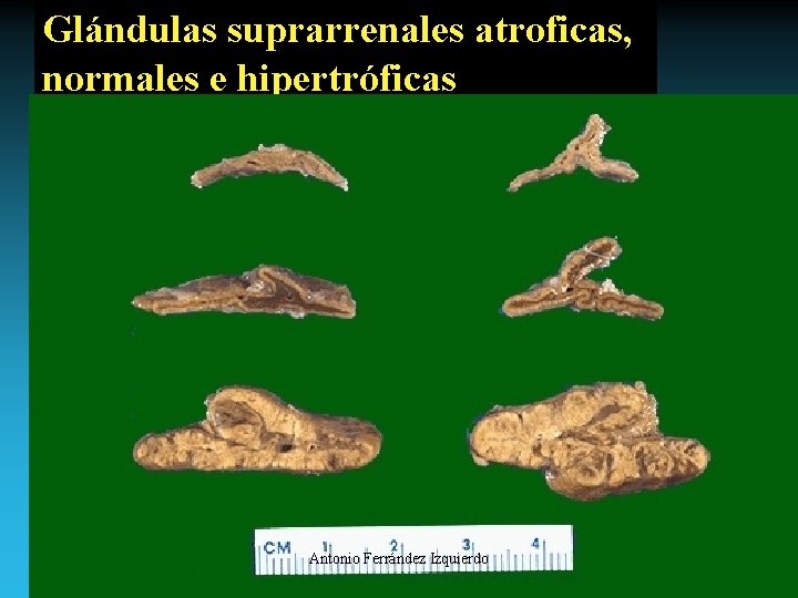 Glándulas suprarrenales atroficas, normales e hipertróficas Antonio Ferrández Izquierdo 